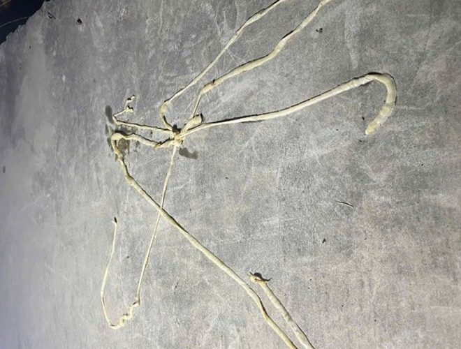 Phát hiện sán lợn dài gần 10m trong cơ thể người đàn ông ở Hải Phòng