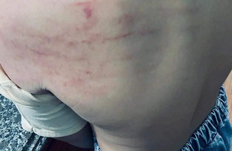 Cô giáo ở Hưng Yên bị tố đ-ánh học sinh lớp 3 bầm tím vì làm thiếu bài tập về nhà